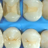 Intarsi dentali
