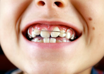 ortodonzia infantile: apparecchi 